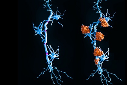 دانشمندان کشف کردند که بیماری ام‌اس ممکن است دو زیرگروه مجزا داشته باشد